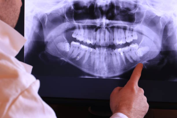 Best Emergency Wisdom Tooth Extraction in Willis, TX