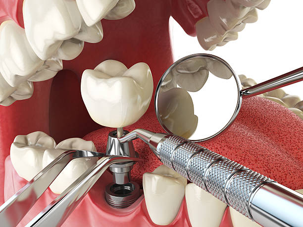 Best Emergency Root Canal Therapy in Willis, TX